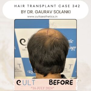 Hair Transplant Case 342 - Before Treatment at Cult Aesthetics Gurgaon
