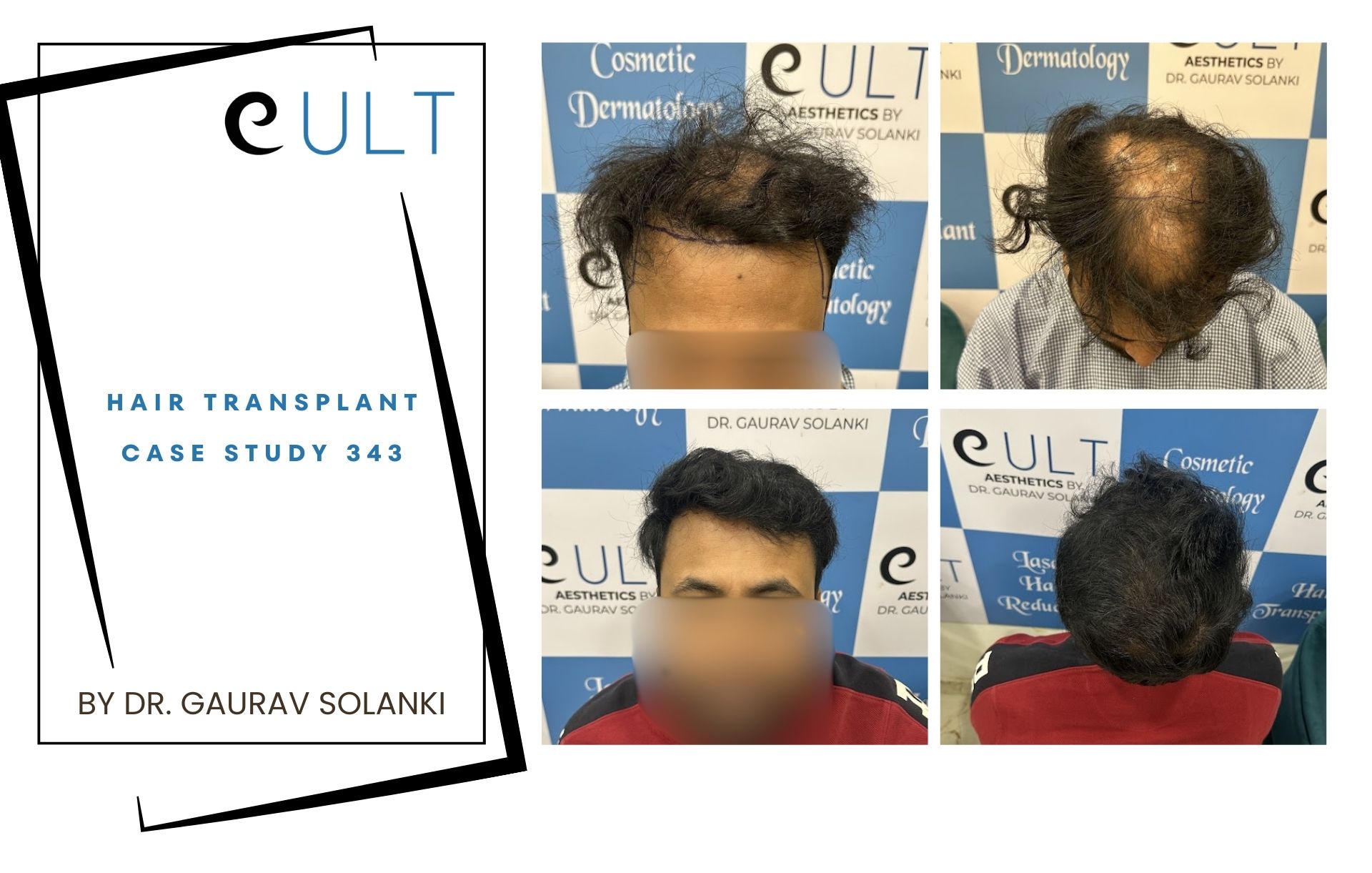 Hair Transplant case 343