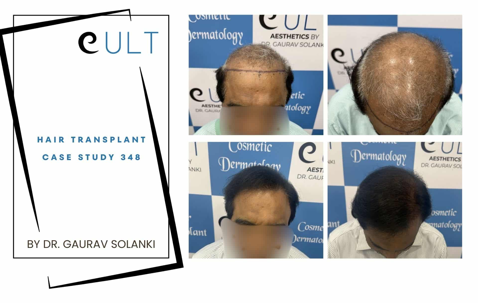 Hair Transplant case 348