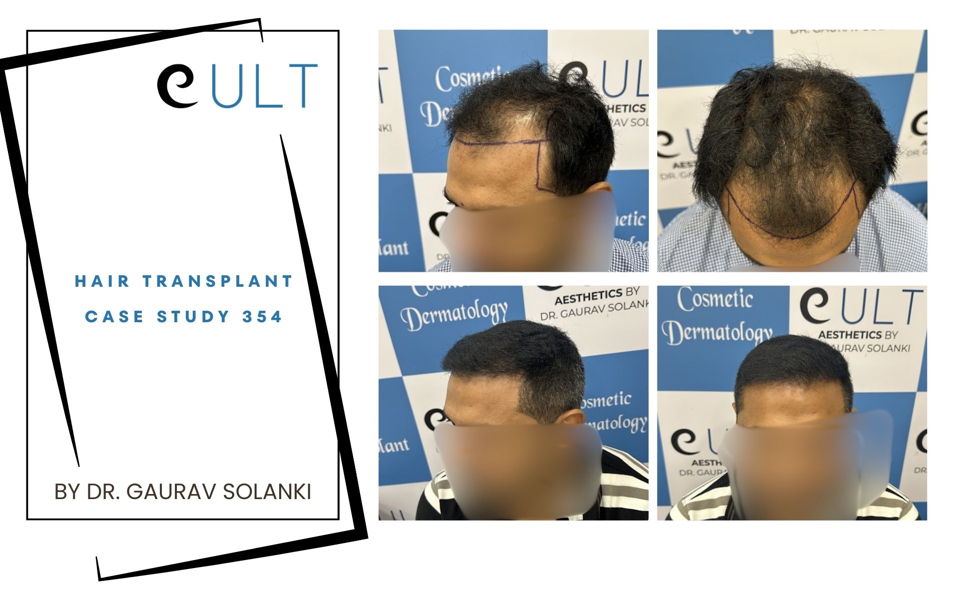Hair Transplant case 354