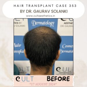 Hair Transplant Case 353 - Before Treatment at Cult Aesthetics Gurgaon