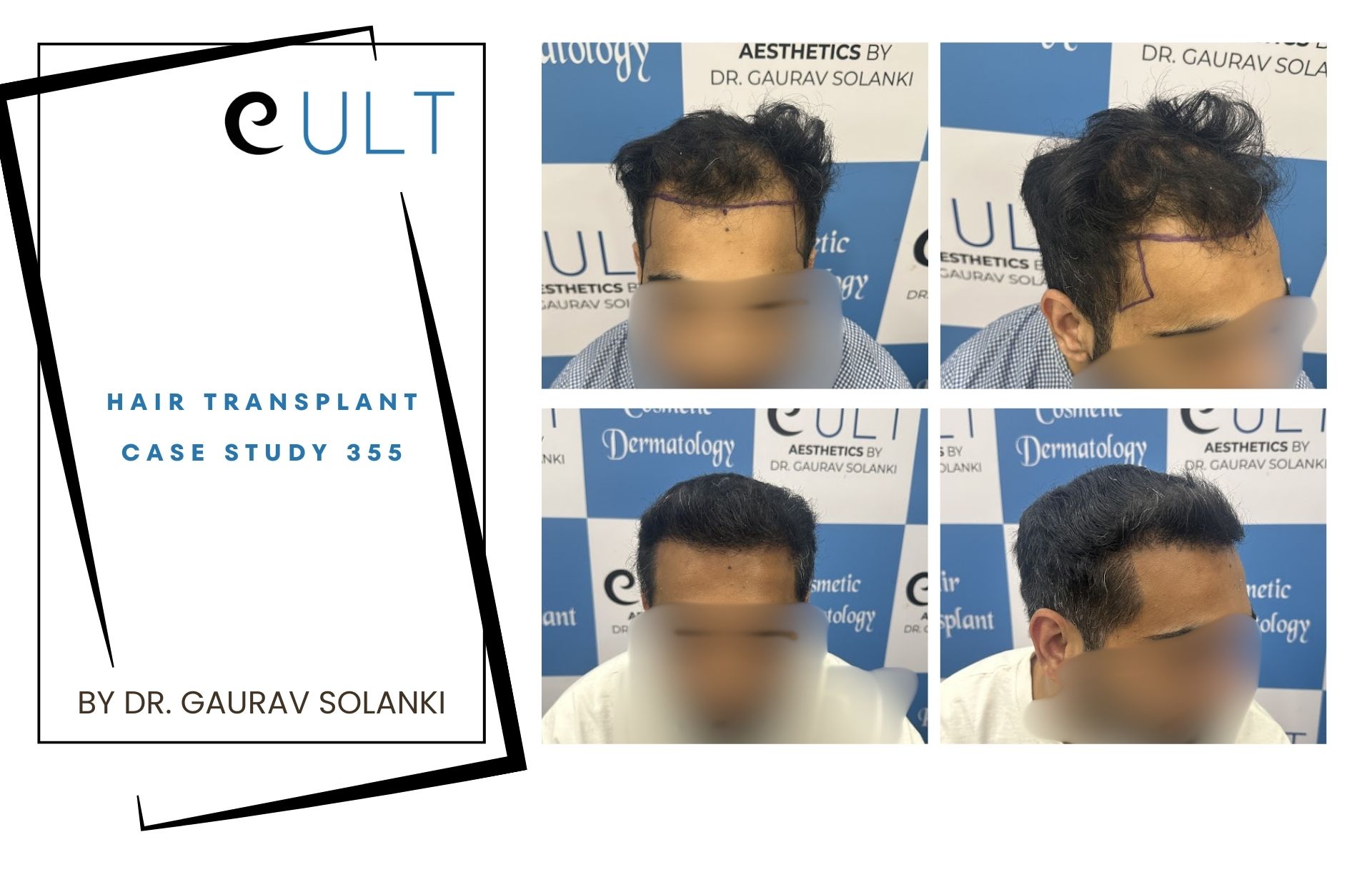 Hair Transplant case 355