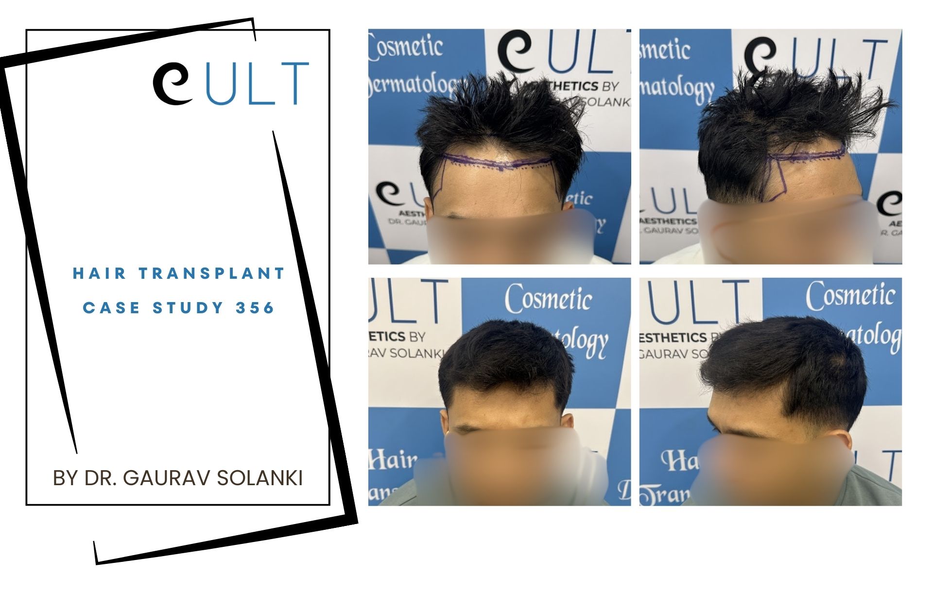 Hair Transplant case 356