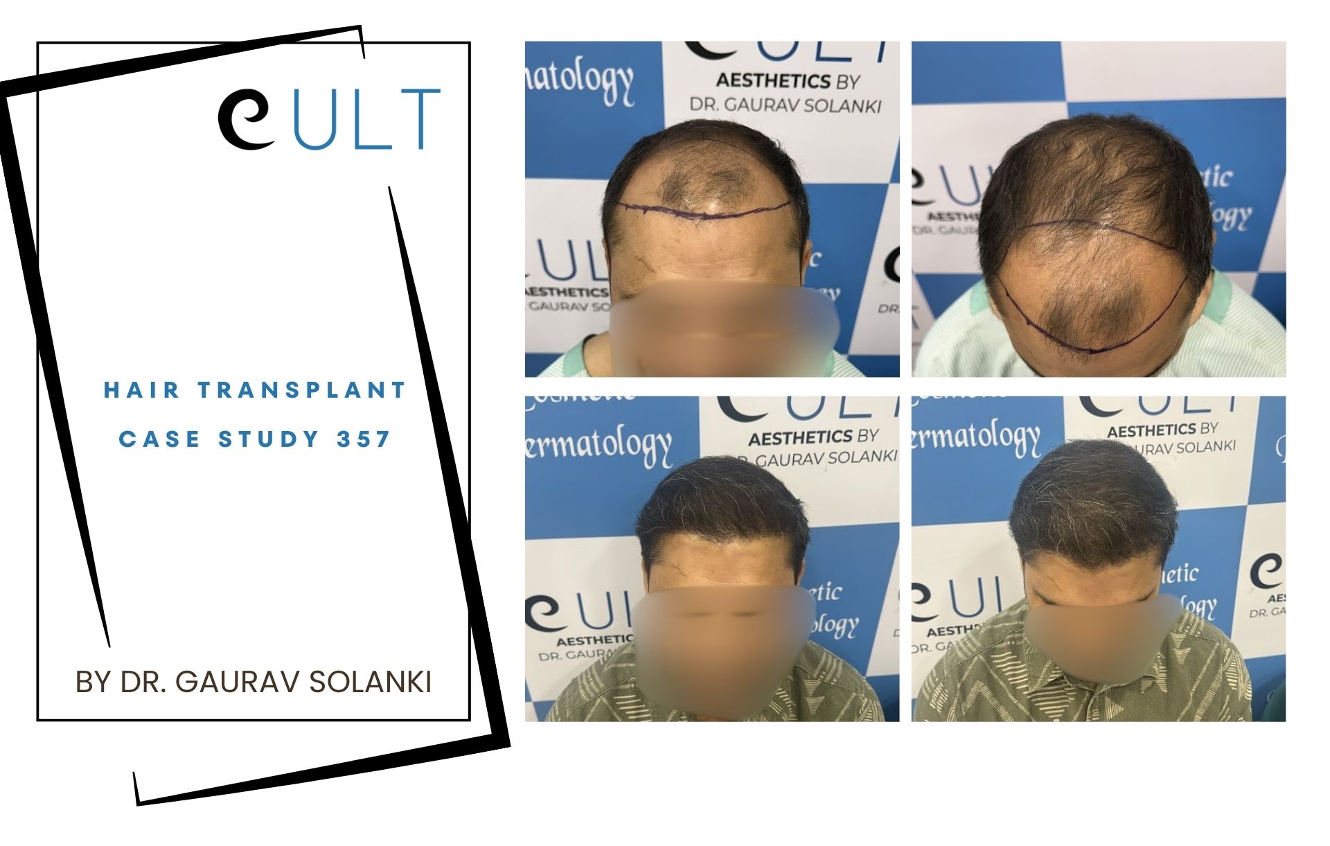 Hair Transplant case 357