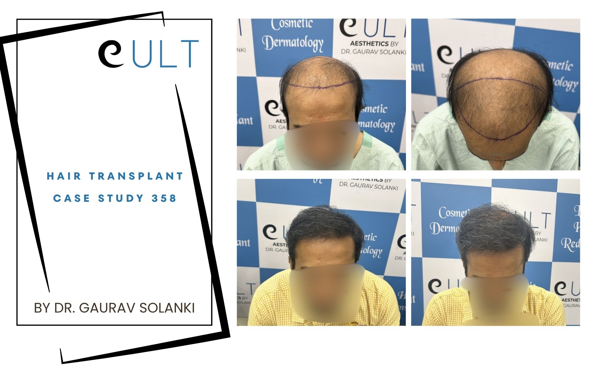 Hair Transplant case 358