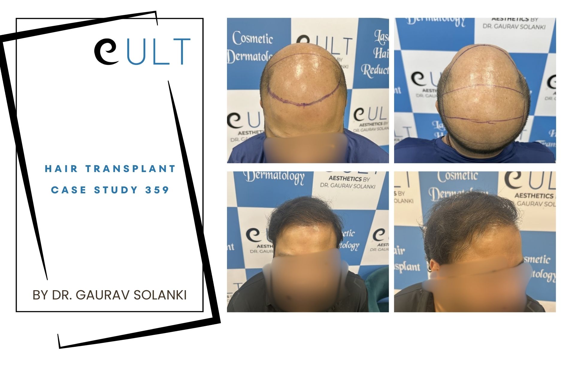 Hair Transplant case 359