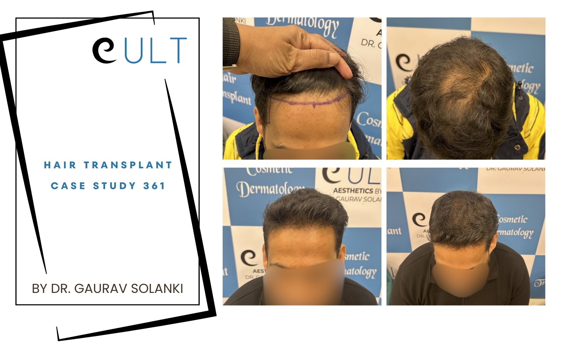 Hair Transplant case 361