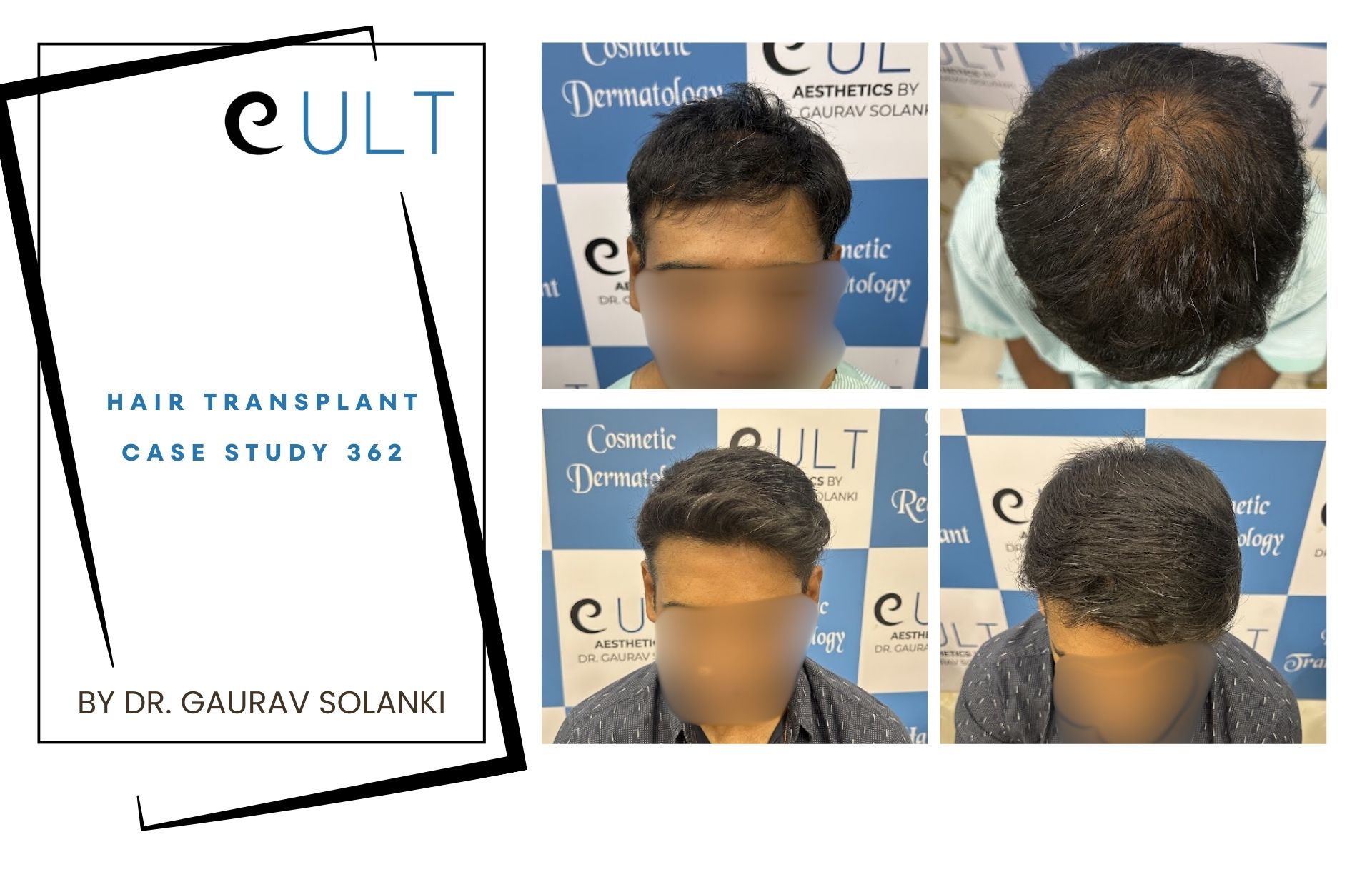 Hair Transplant case 362