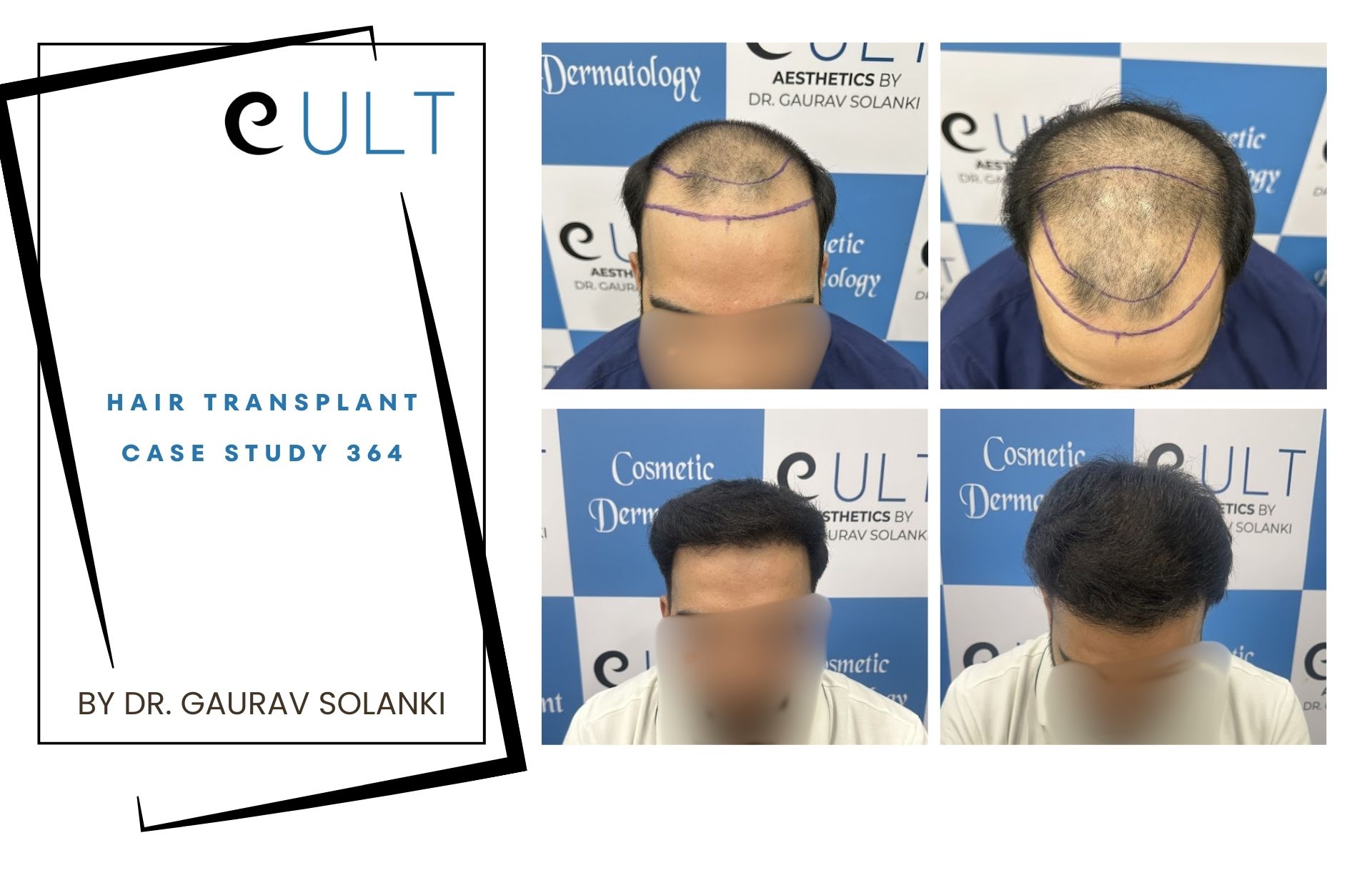 Hair Transplant case 364