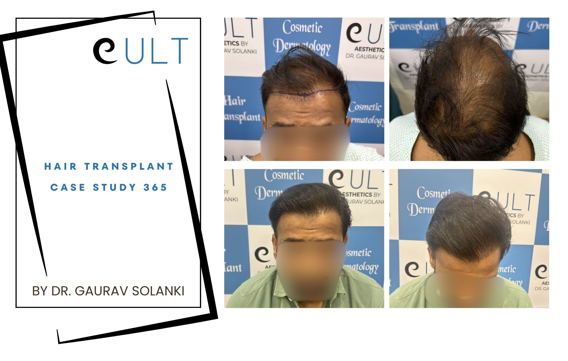 Hair Transplant case 365
