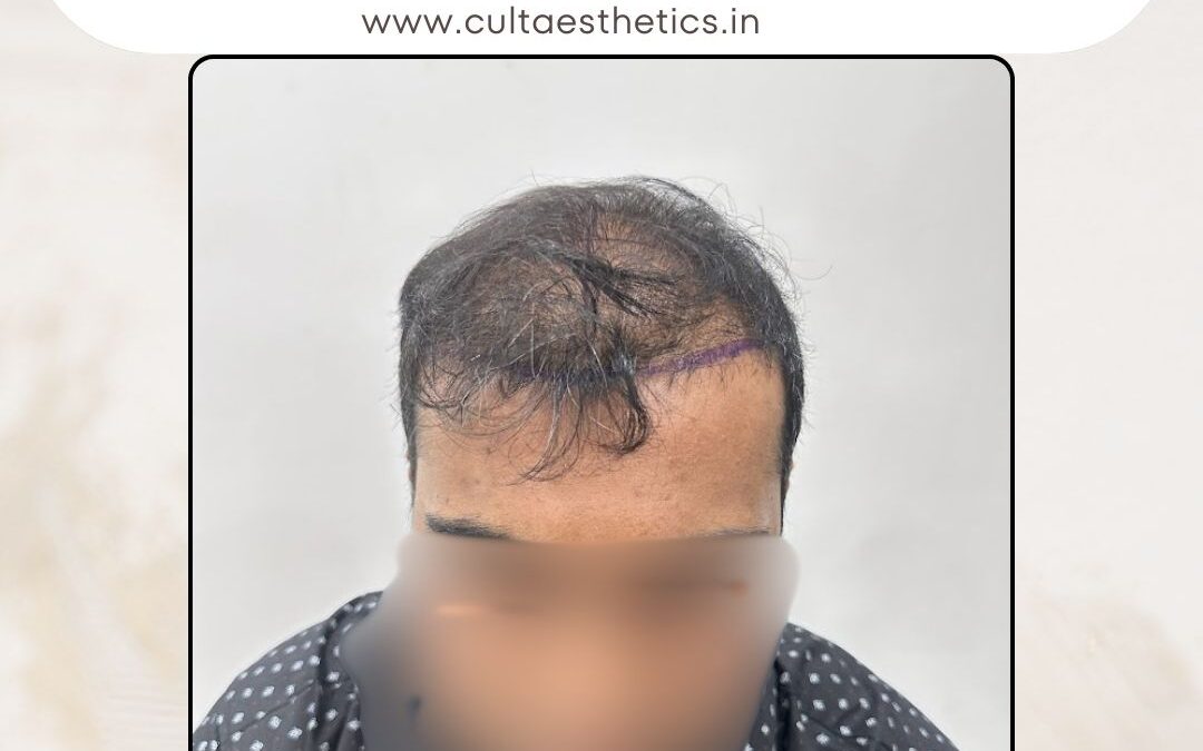 Hair Case 363 Before 1