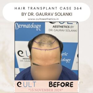 Hair Transplant Case 364 - Before Treatment at Cult Aesthetics Gurgaon