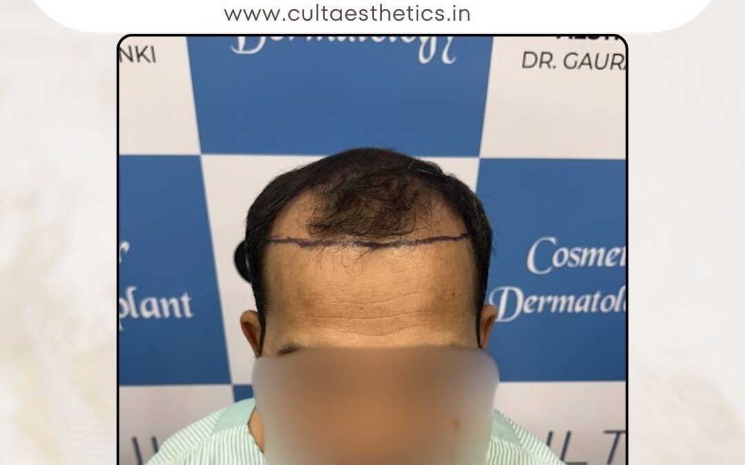 Hair Case 366 Before 1