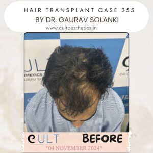 Hair Transplant Case 355 - Before Treatment at Cult Aesthetics Gurgaon