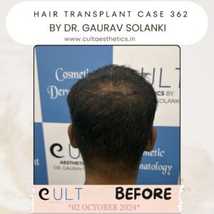 Hair Transplant Case 362 - Before Treatment at Cult Aesthetics Gurgaon