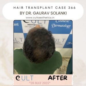 hair case 366 After-3