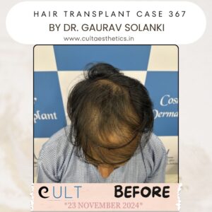 Hair Transplant Case 367 - Before Treatment at Cult Aesthetics Gurgaon