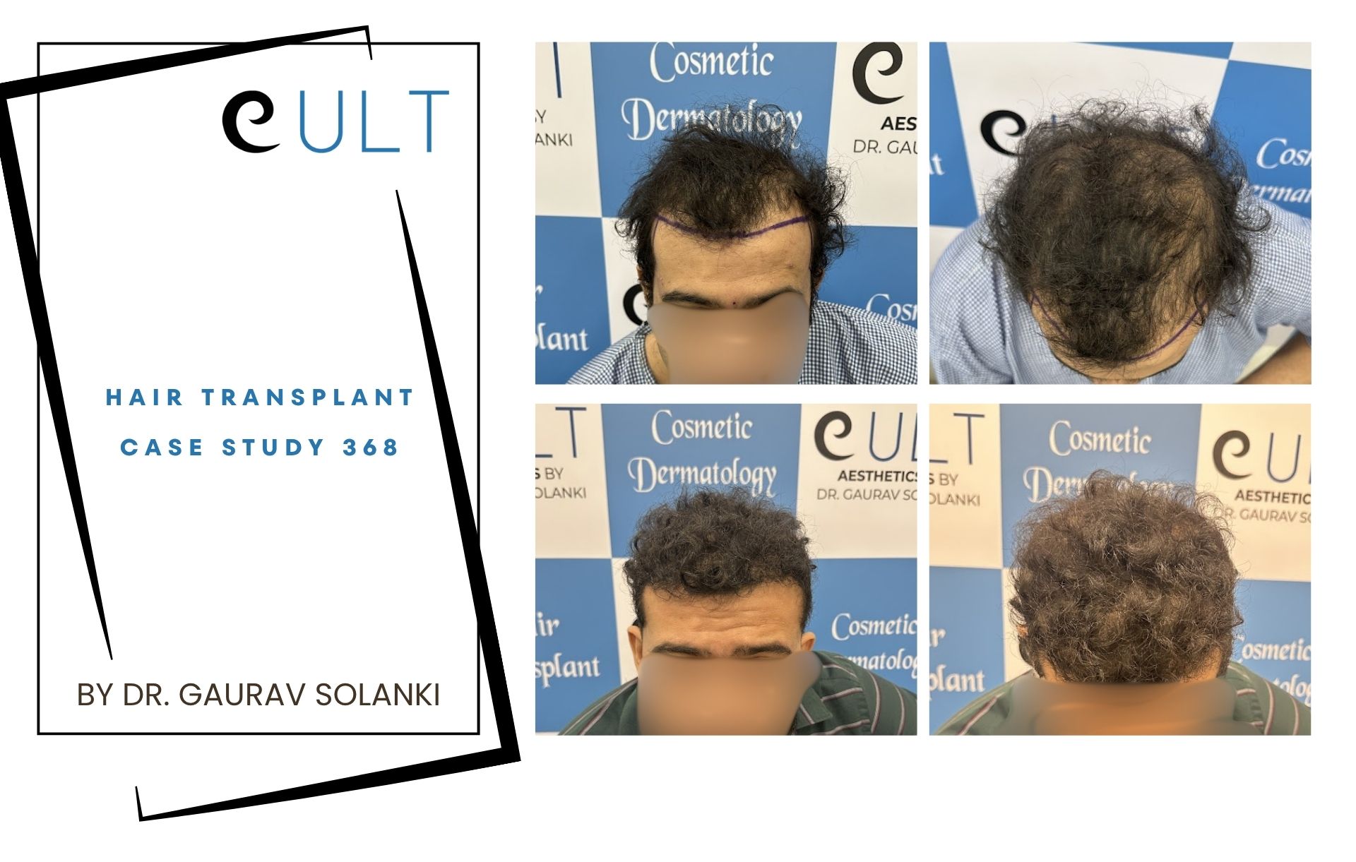 Hair Transplant case 368