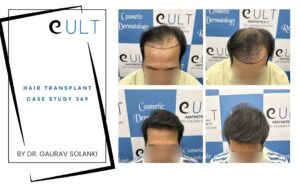 Hair Transplant case 369