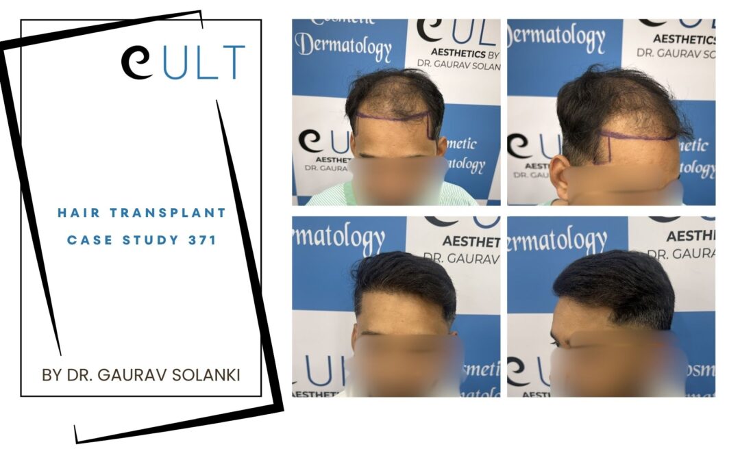 Hair Transplant Case 371