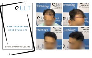 Hair Transplant case 371