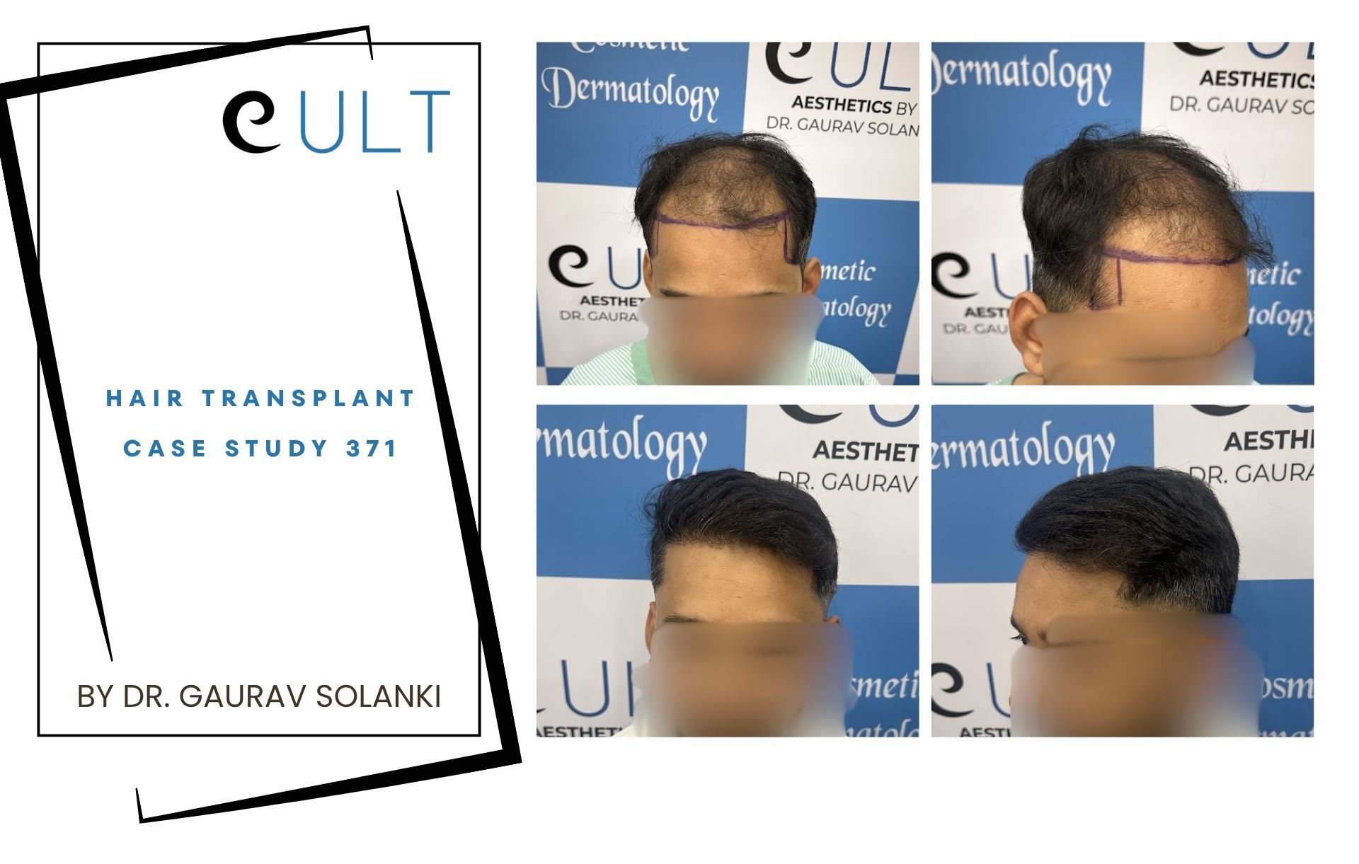 Hair Transplant case 371