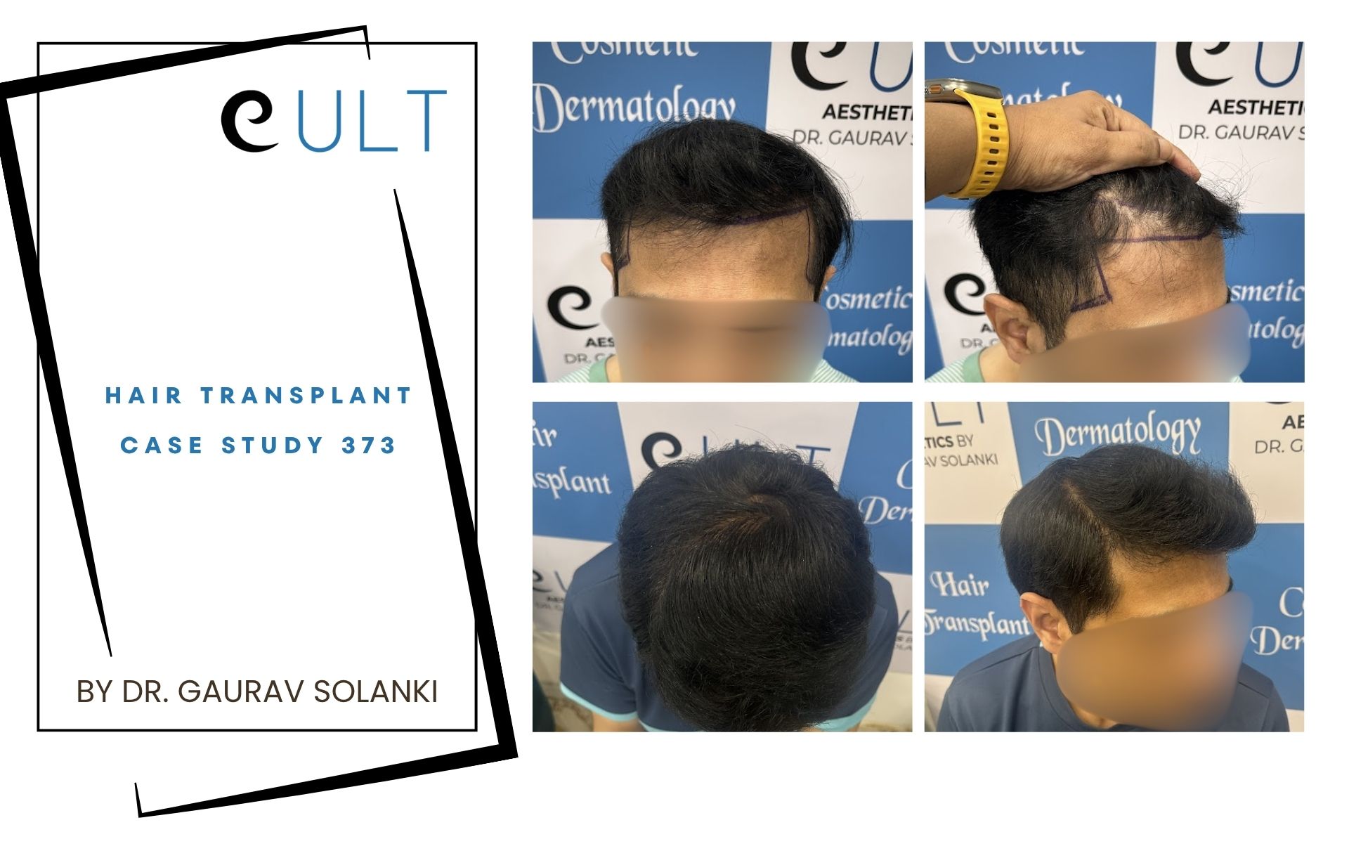 Hair Transplant case 373