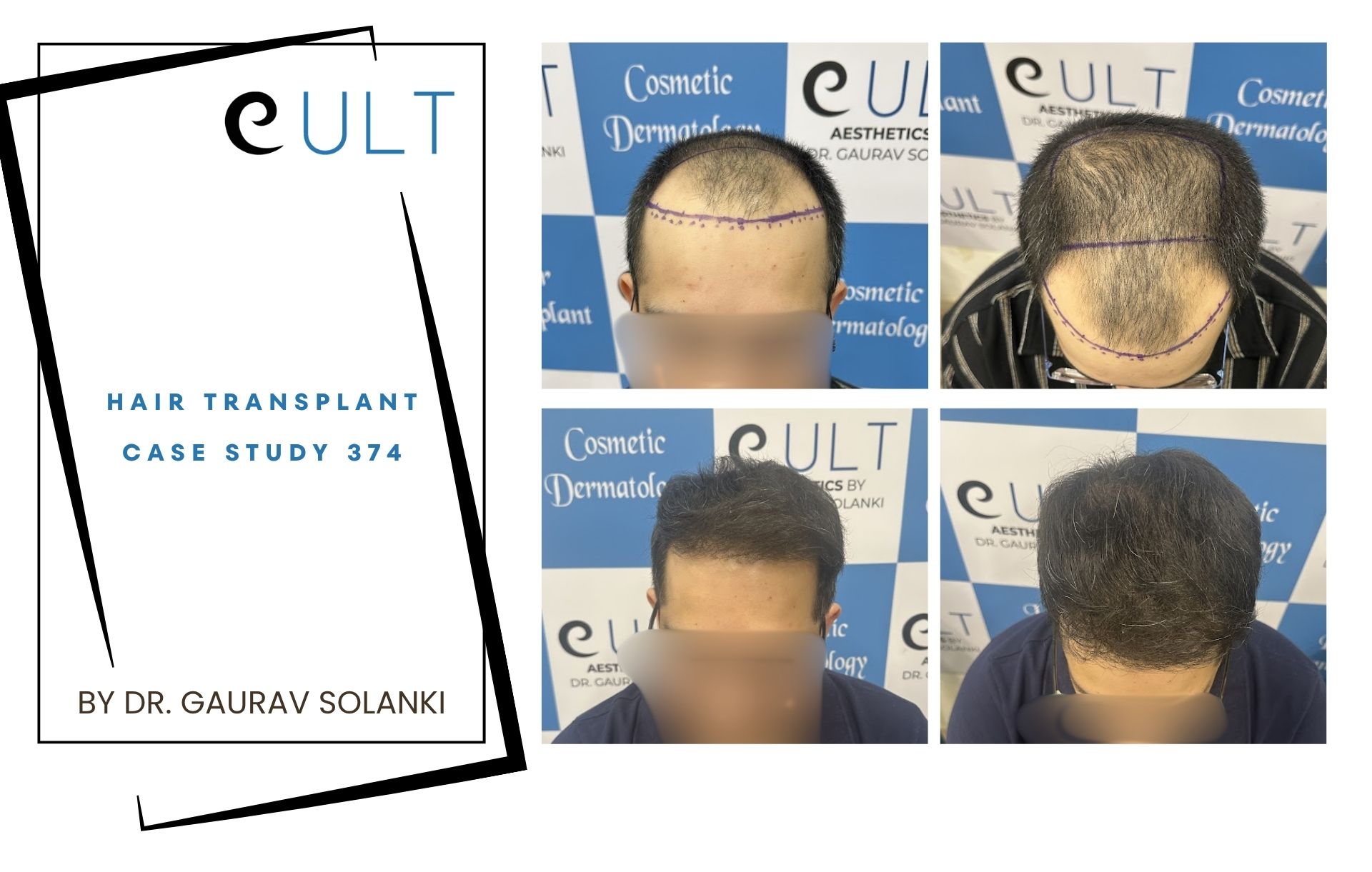 Hair Transplant case 374