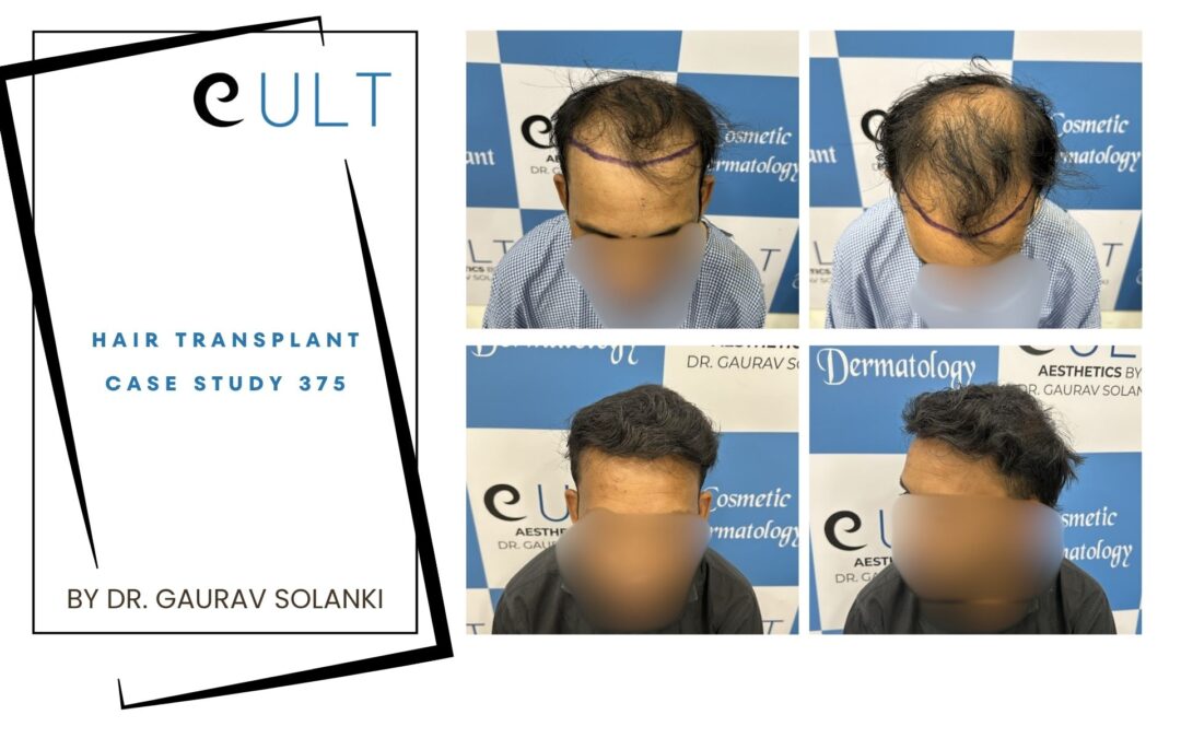 Hair Transplant Case 375
