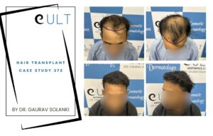 Hair Transplant case 375