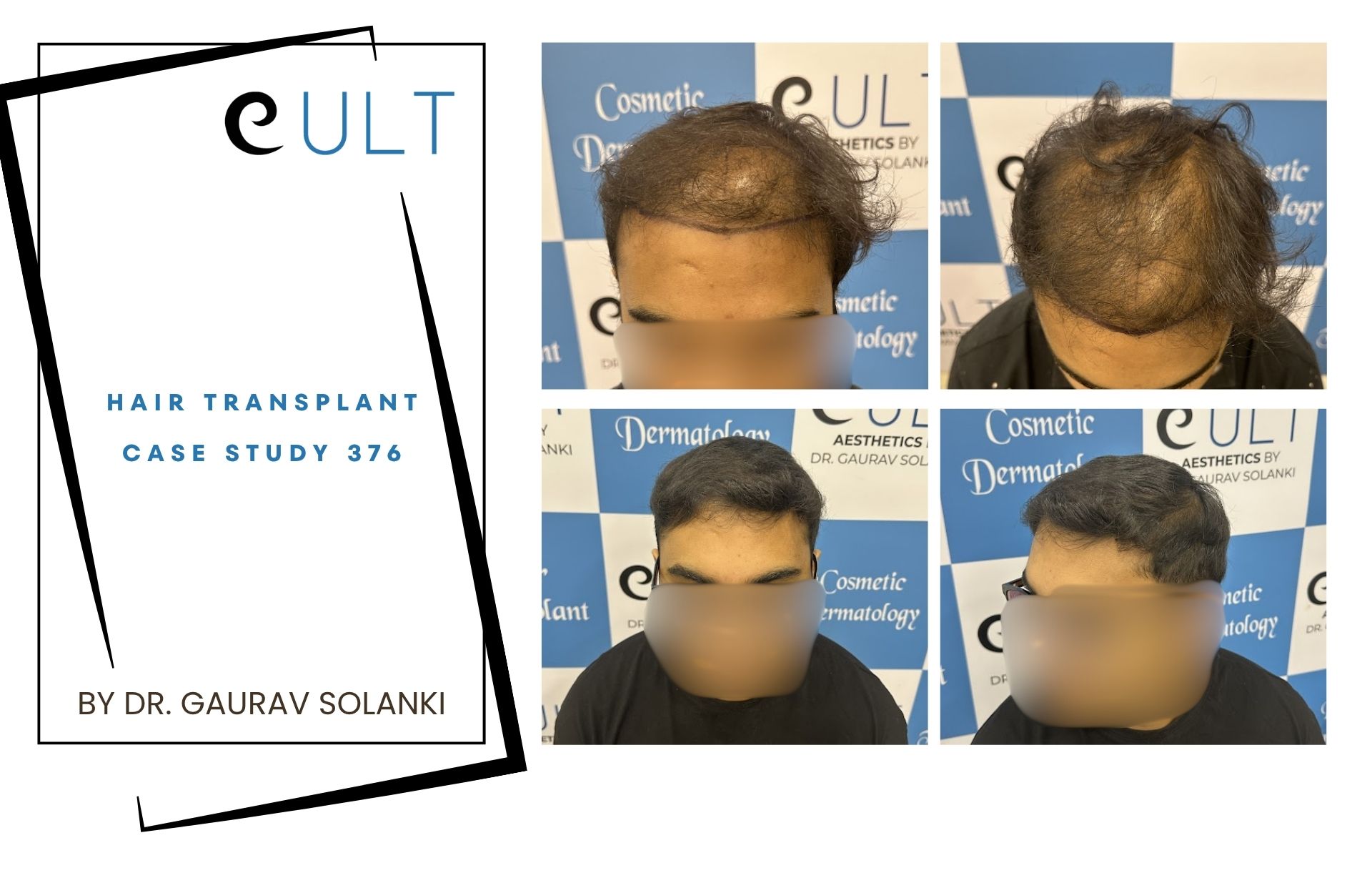 Hair Transplant case 376