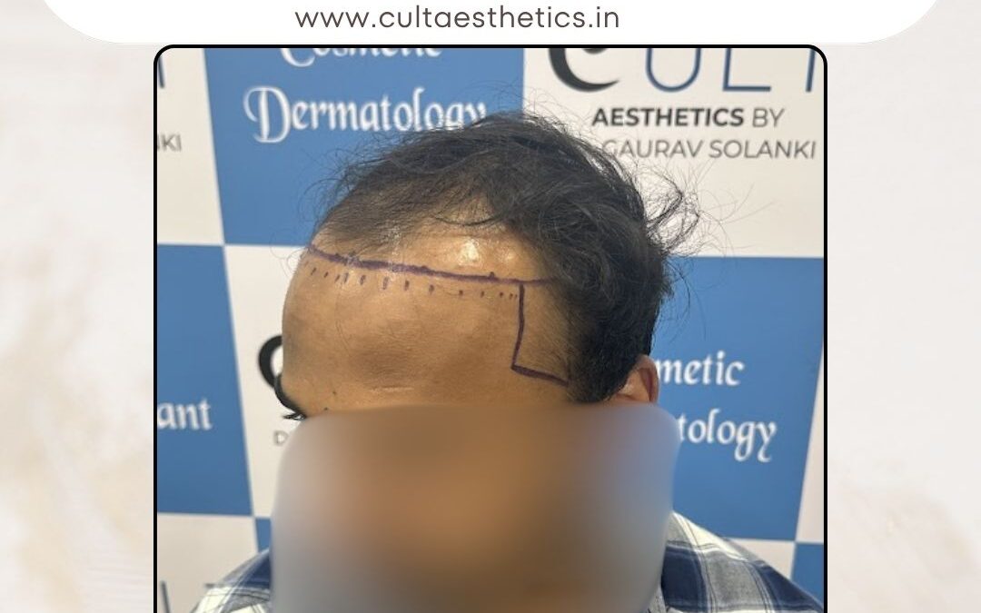 Hair Case 370Before 1