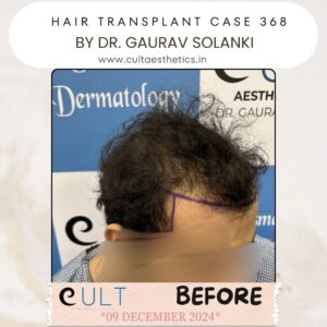 Hair Transplant Case 368 - Before Treatment at Cult Aesthetics Gurgaon