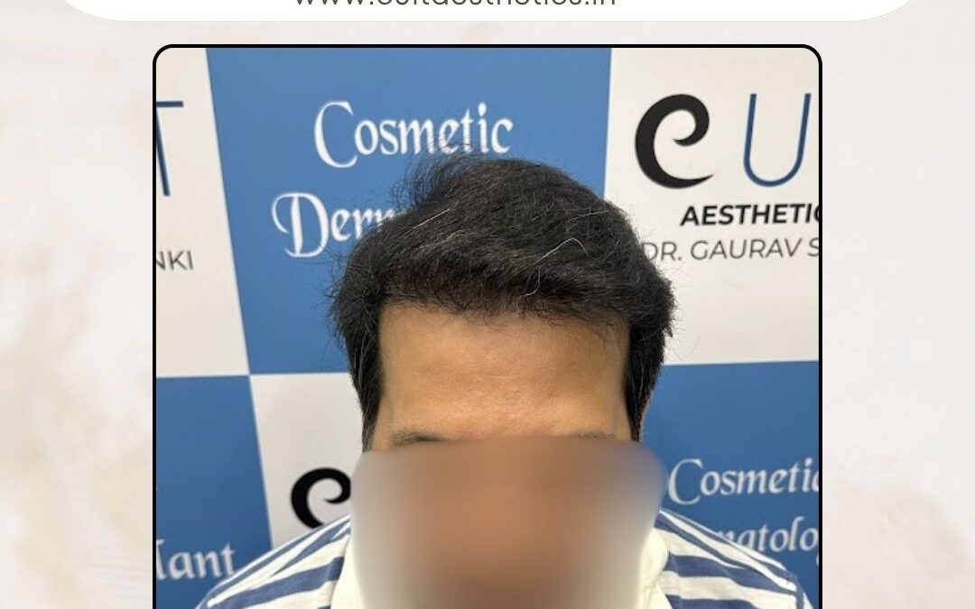 Hair Case 369 After 1