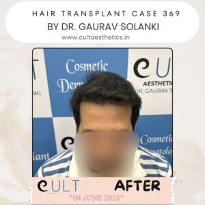 hair case 369 After-1