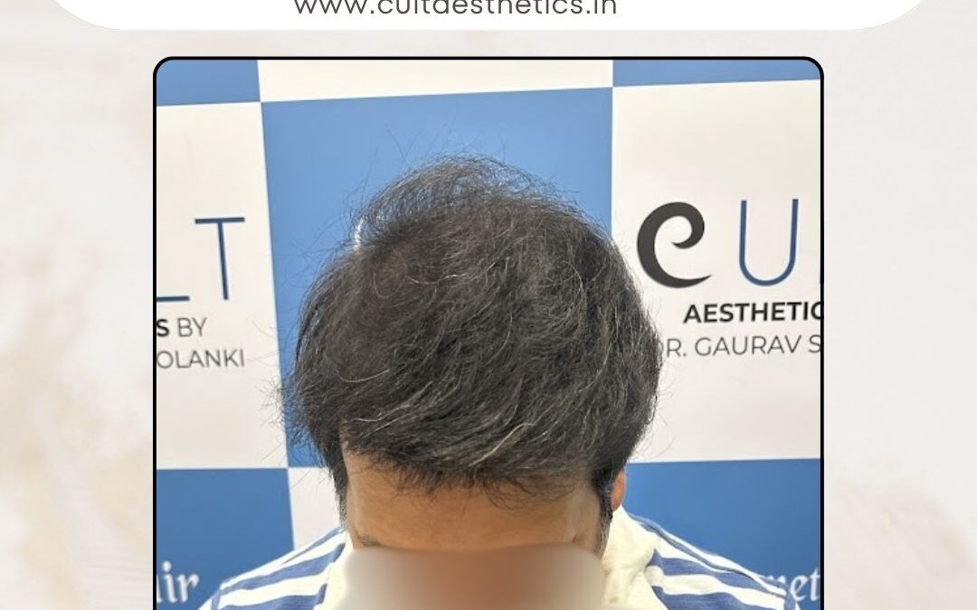 Hair Case 369 After 2