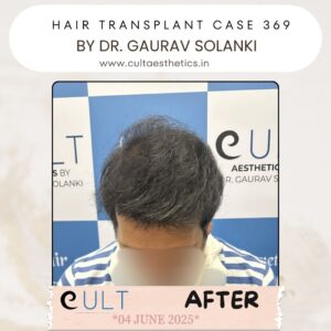 hair case 369 After-2