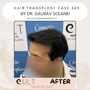 hair case 369 After-3