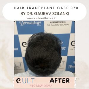 hair case 370 After-3