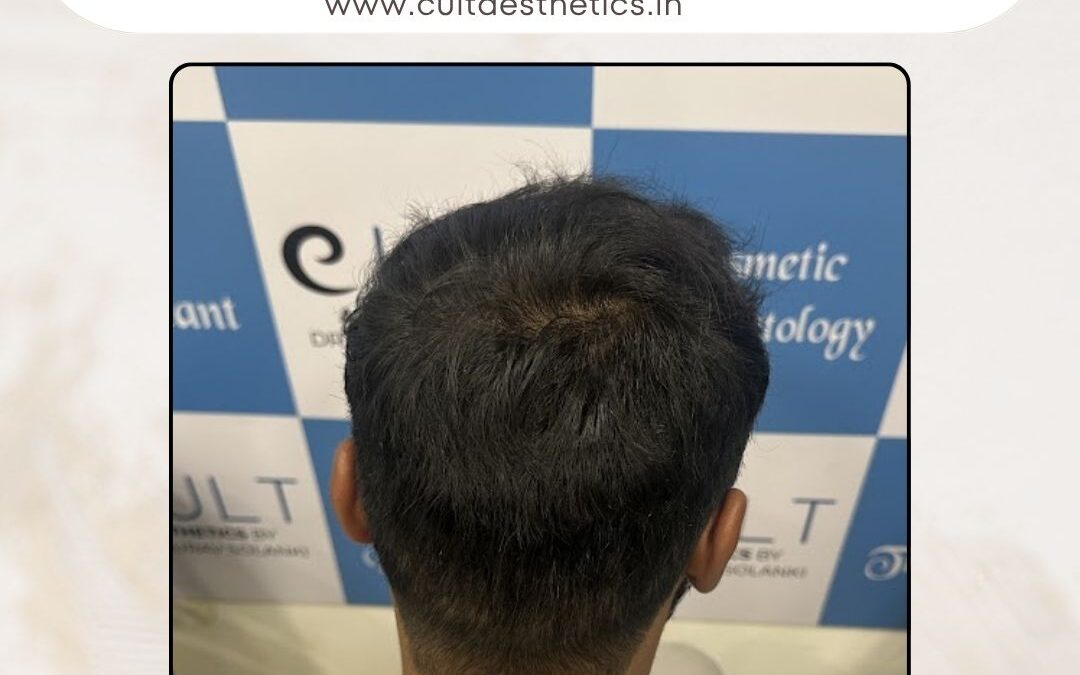 Hair Case 370 After 4