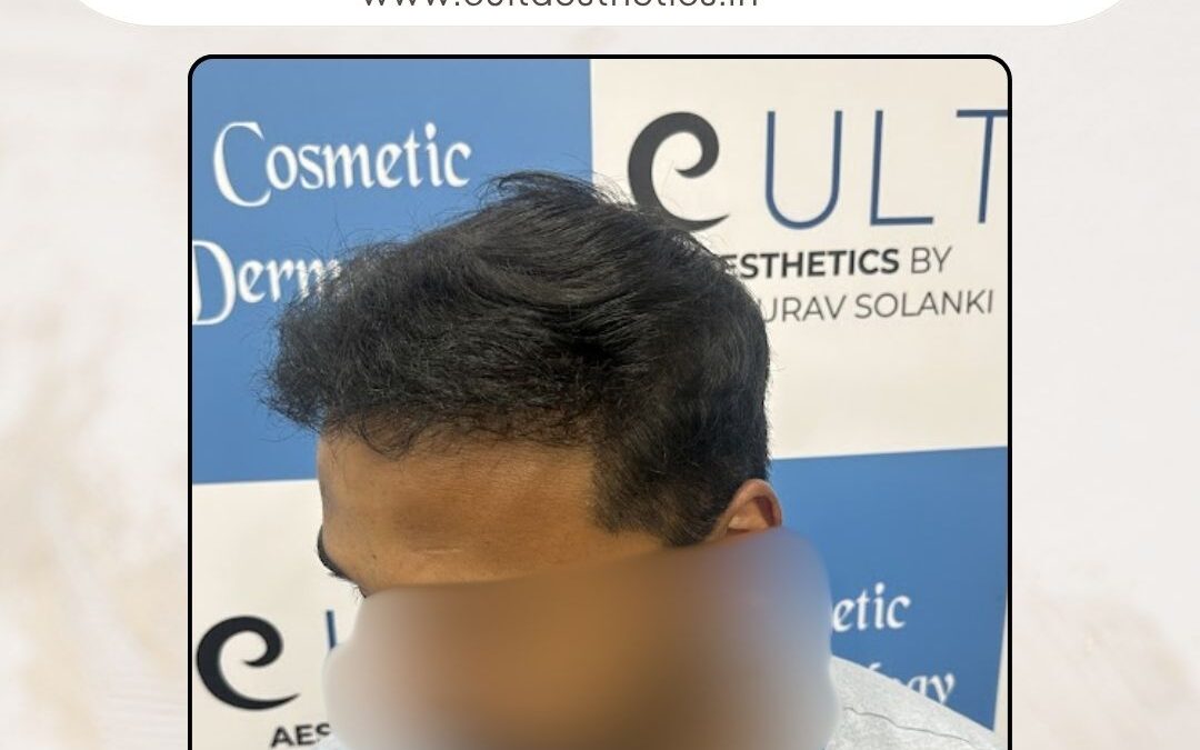 Hair Case 370After 1