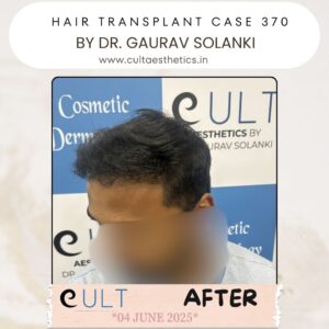 hair case 370After-1