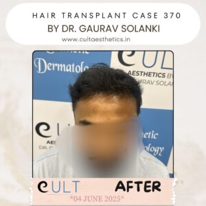 hair case 370After-2