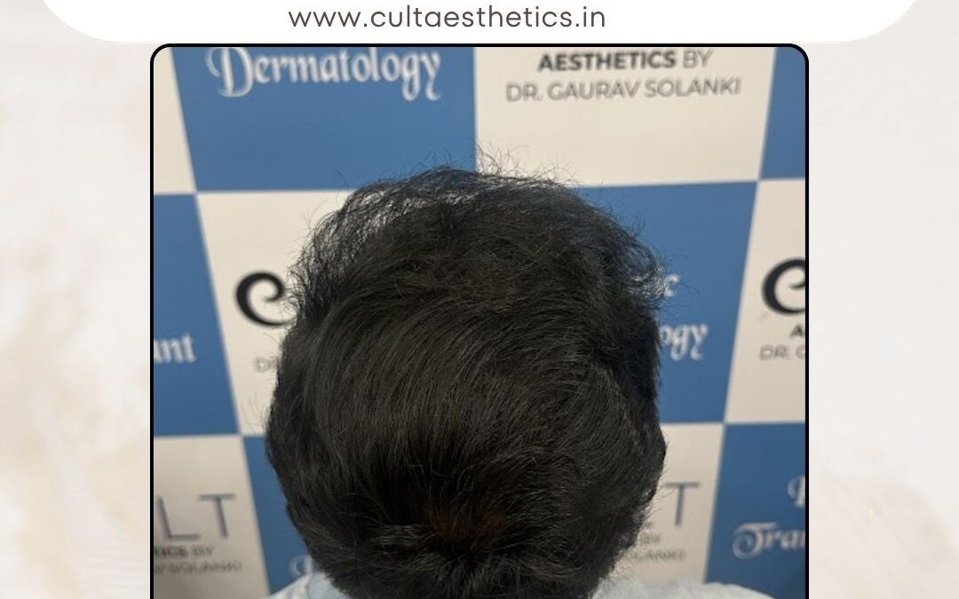 Hair Case 370After 3