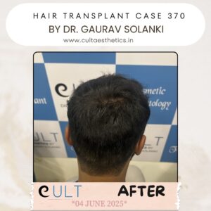 hair case 370After-4