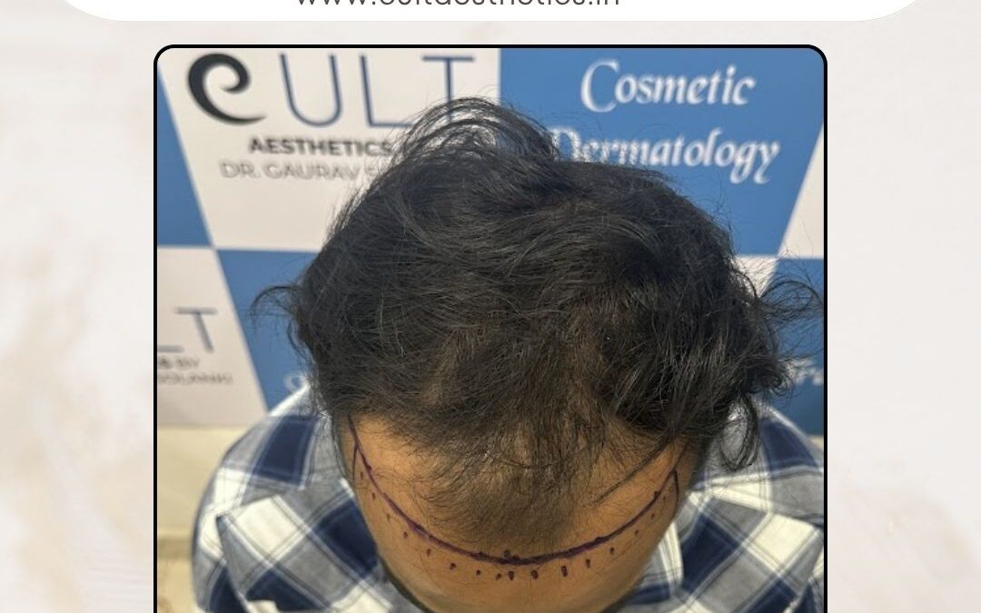 Hair Case 370Before 2
