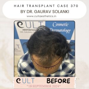 hair case 370Before-2