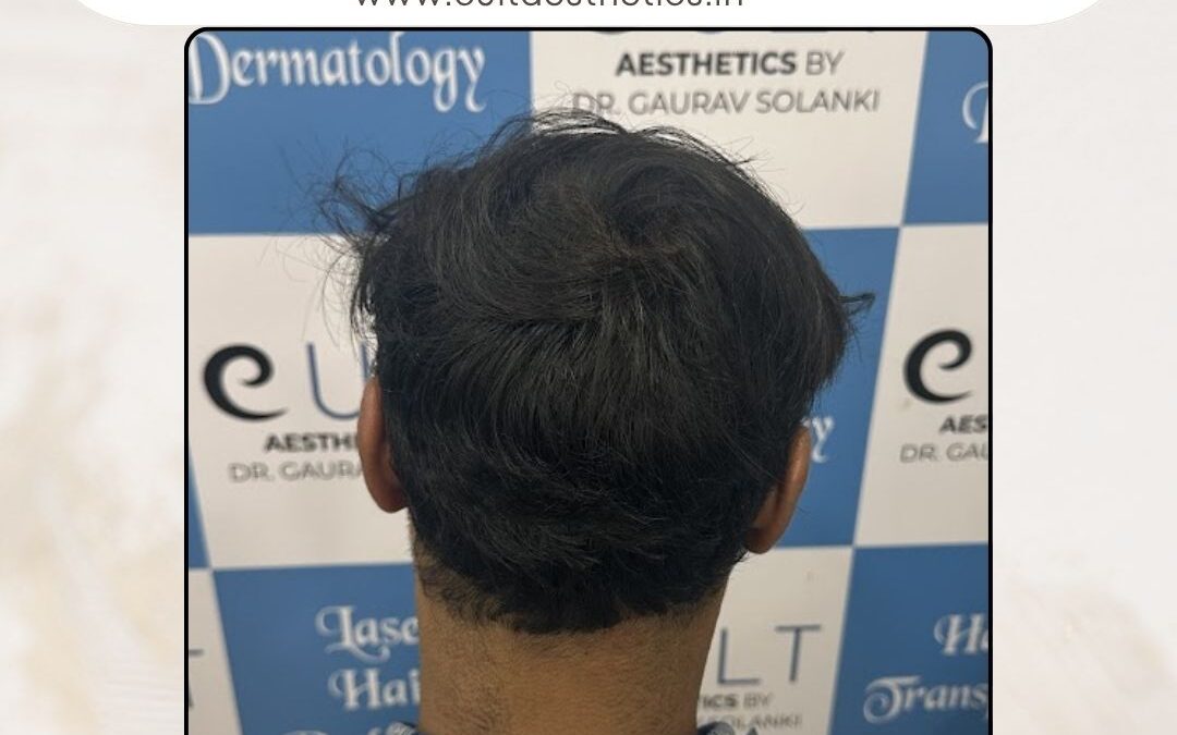 Hair Case 370Before 4