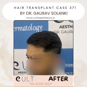 hair case 371 After-3