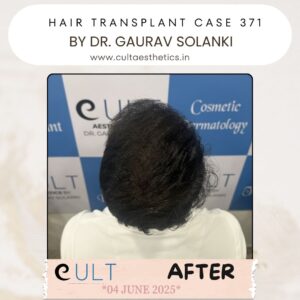hair case 371 After-4